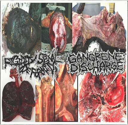 Gangrene Discharge : Rigidity Spinal Deformity - Gangrene Discharge